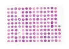 TriStar - Model TA3089 - Hematological Cancers: MZL, FL, MCL, CLL/SLL, DLBCL, Hodgkin’s Lymphoma with histopath data  1mm