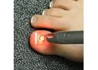 Mobile Nail Laser Service