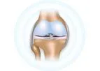 Hyalex - Cartilage