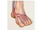 LimFlow - Chronic Limb- Threatening Ischemia (CLTI) Technology
