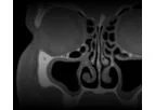 PROPEL - Sinus Implants