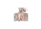 CardioGenesis - Cardiac Laser Therapy