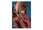 Impella - Model 5.5 - Minimally Invasive Heart Pump with Smart Assist