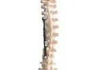 ApiFix - Model MID-C - Adolescent Idiopathic Scoliosis (AIS)
