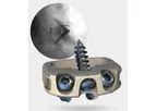 Stalif - Model M Ti - No-Profile Anterior Lumbar Integrated Interbody System