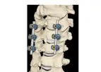 Model ALTOS PCT - Evolving the Gold Standard in Cervical Spinal Fusion Procedures