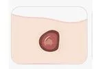 MaxioCel - Highly Absorbent Wound Dressing