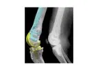 Prophecy - Personalized Knee Solutions