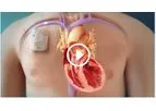 Optimizer - Cardiac Implantable Device