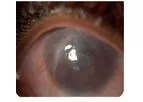 Electrospinning - Cornea Regeneration