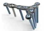 Acumed - Ankle Plating Fixation System