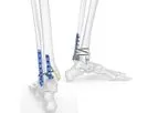 Acumed - Model 3 - Ankle Plating Fixation System