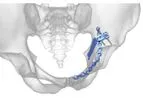 Acumed - Pelvic Plating System