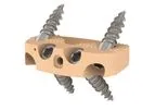 Medicrea IMPIX ALIF SA - Anterior Stand-Alone Lumbar Cage