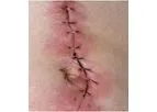 IonoStim - Wound Healing Clinical Pipeline