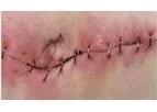 Ionosite - Surgical Site Infection Clinical Pipeline