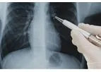 Vuno Med - Chest X-ray Software