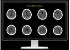 Rapid - Version ICH - Identifies Suspected Intracranial Hemorrhage Software
