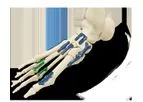 ARSENAL - Foot Plating System