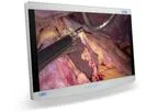Radiance - Model Ultra 32 Inch - Premium Endoscopy Visualization Display