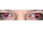 Customflex Artificialiris - Medical Device