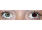 Customflex Artificialiris - Custom-Color Match Medical Device