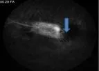 Cerevast - Microsphere-Mediated Ophthalmic Ultrasound