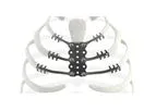 Neuro - Model Trionyx - Sternal Replacement Implant