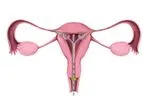 FemBloc - Permanent Birth Control Device