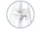 Medacta - Model BIKINI - Anterior Minimally Invasive Surgical Hip Replacement Joint (AMIS)