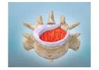 Model KUR-113 - Drug-Biologic Combination for Spinal Fusion