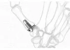 Stablyx - Model CMC - Arthroplasty System