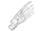 JAWS - Nitinol Staple System