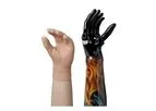 Motoric - Model INDY - Forearm Prosthesis