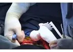 Bone Tumor Resection