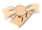 Advazorb - Absorbent Foam Dressing with Film Backing