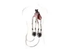 EXCOR - Model Adult - Mechanical, Pulsatile Heart Support System