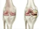 Moximed - Joint Unloading for Patients
