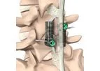 LimiFlex - Dynamic Sagittal Tether