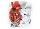 WiSE - Cardiac Resynchronization Therapy (CRT) System
