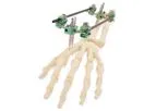 AOS - Small Bone External Fixation System