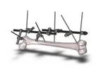 MedSpark - Large Bone External Fixation System