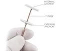 Revivent TC - Anteroseptal Anchor System Implant