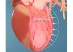 Ancora Accucinch - Ventricular Restoration System for Patients