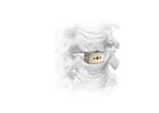 Crystal - Model Ti-Bond - Cervical Interbody System