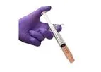 Orios - Model XT - Viable Allogenic Bone Matrix