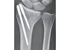 T-Pin - Fixation System for Distal Radius & Distal Ulna Fracture Fixation
