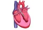Magenta - Model pLVAD - Self-Expanding Percutaneous Left Ventricular Assist Device