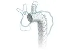 Castor Tevar - Branched Thoracic Stent-Graft System