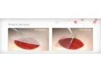 BIOSKIN - Amniotic Wound Matrix
